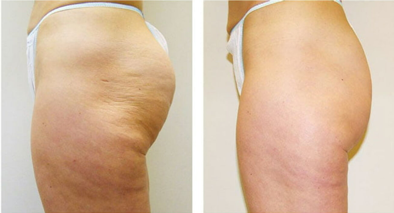 Before and After VelaShape
